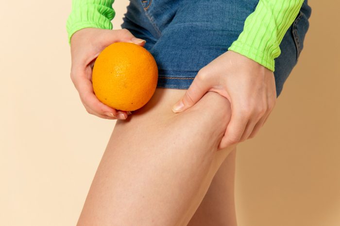 lipedema or just fat legs
